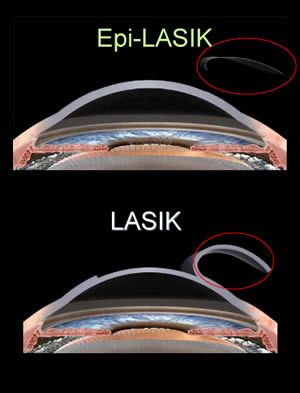 Epi-LASIK vs. LASIK