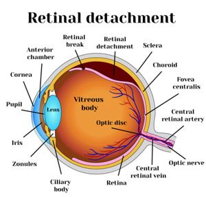 retinal detachment